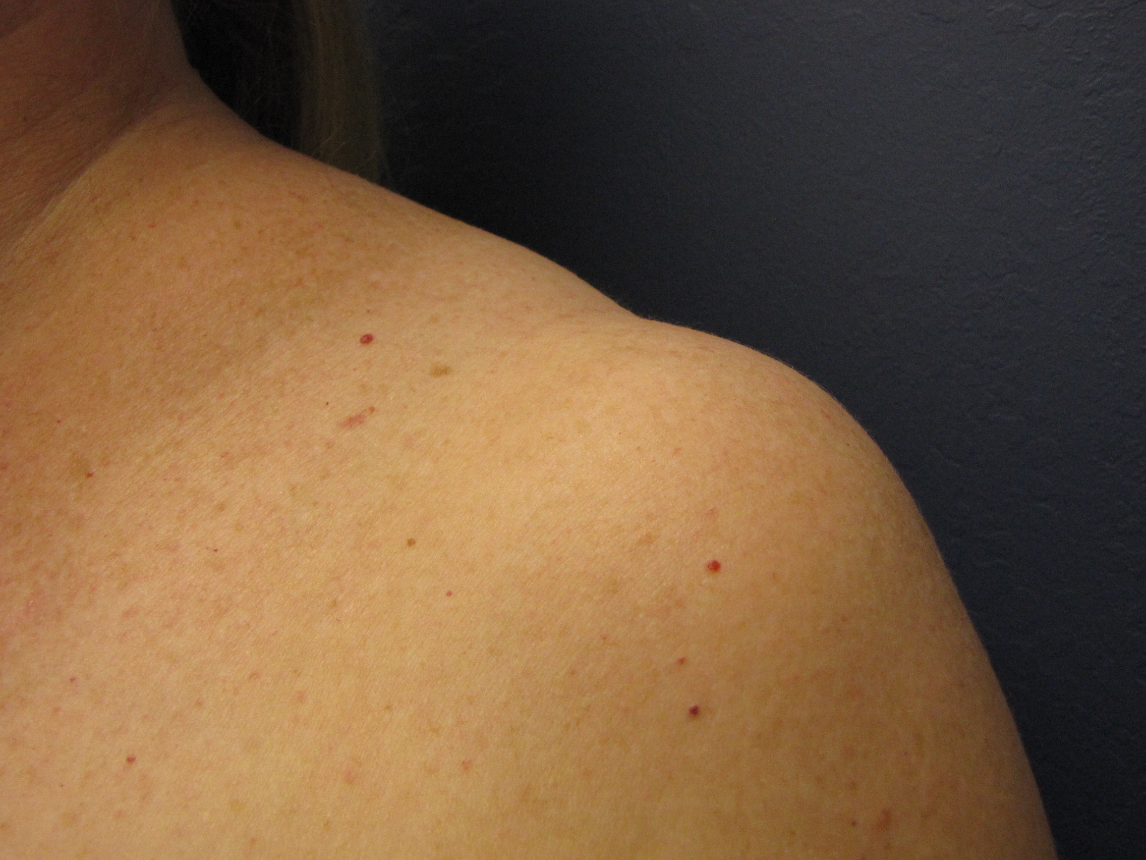 I have indents on my shoulders. Can this be corrected or are my