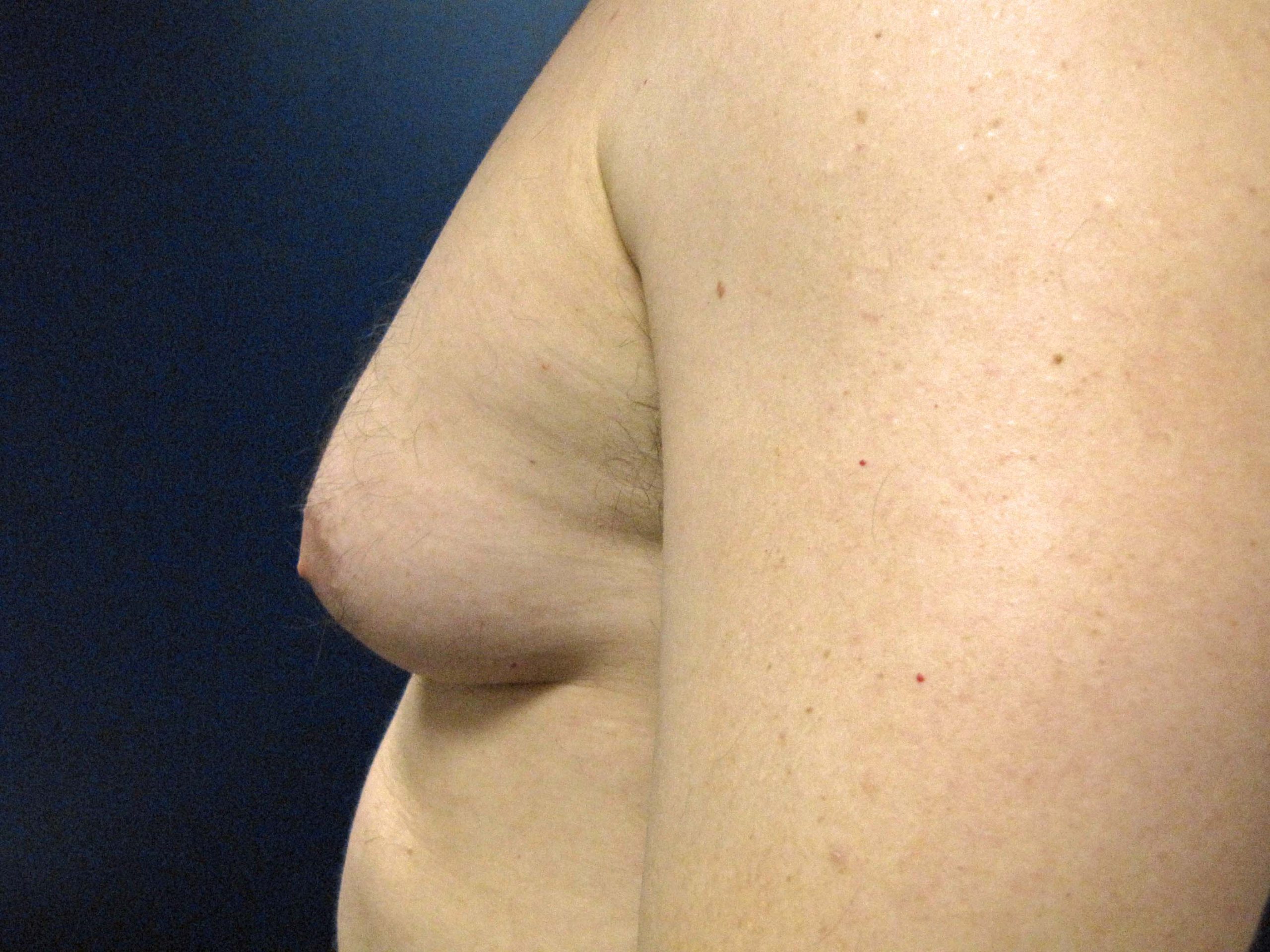 Is this gynecomastia? Please look closely and you will see my left