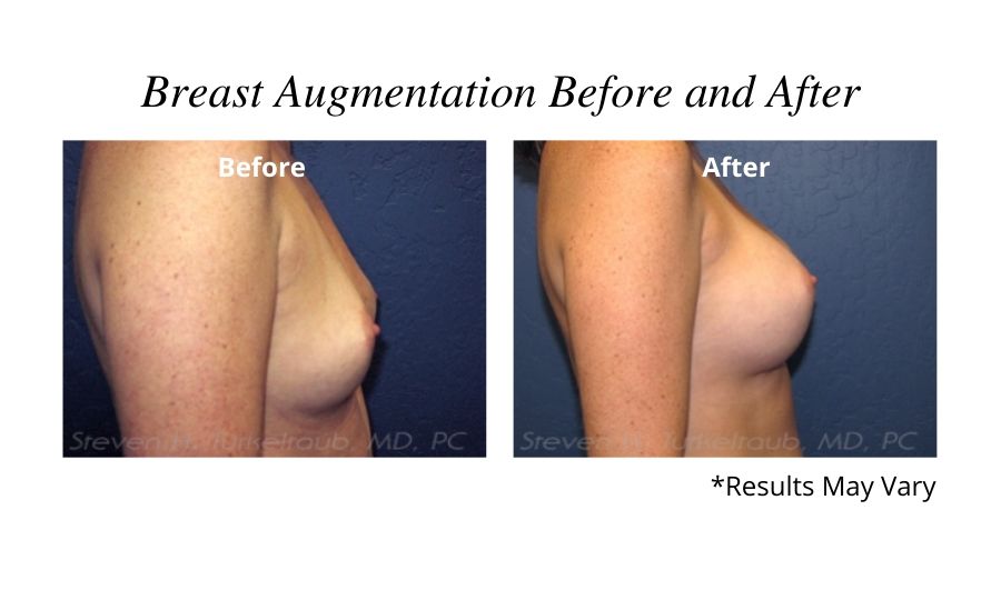 What causes a large gap between breasts after having had a breast  augmentation? (Photo)