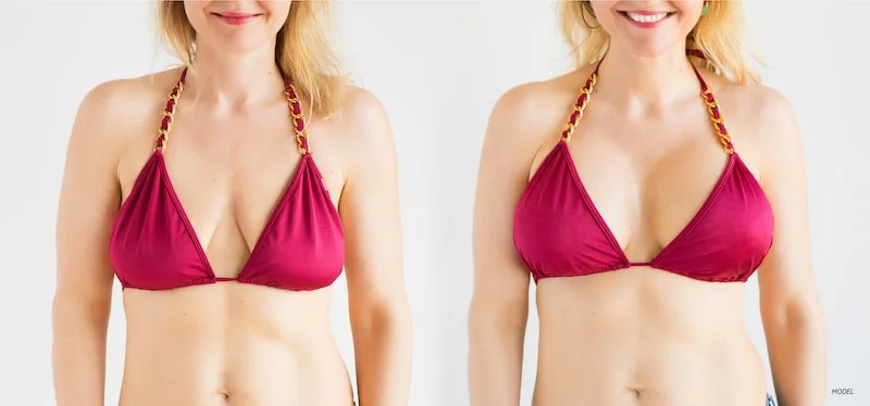 Correction of Sagging Breasts: Learn more about this procedure