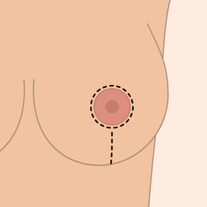 Breast Reduction Techniques