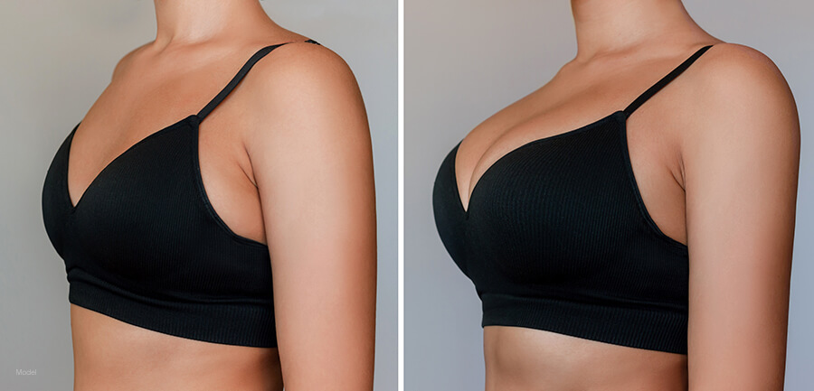 Sagging Breasts? Here's Why Breast Augmentation With a Lift is the