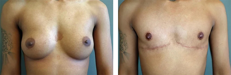 Top surgery scar before and after photo