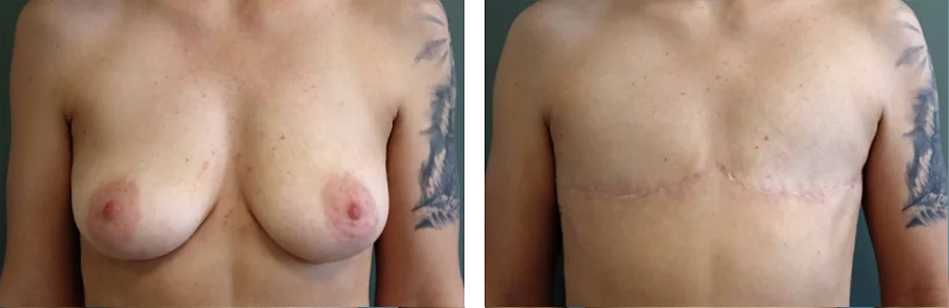 Top surgery scar patient before and after photo 