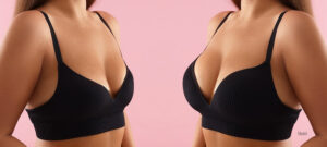 Woman in a black undergarment before and after breast surgery.