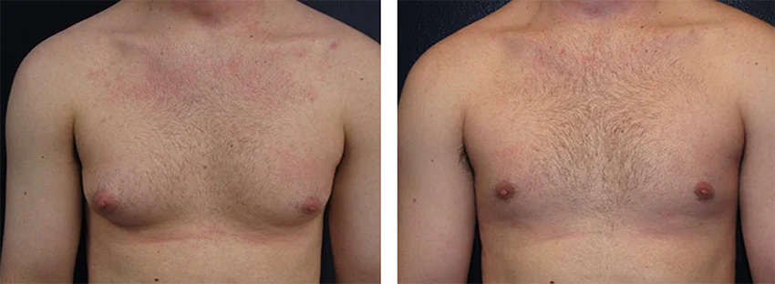 Before and After photo for gynecomastia surgery by Steven H. Turkeltaub, M.D.