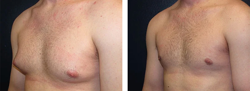 Before and After photo for gynecomastia surgery side view by Steven H. Turkeltaub, M.D.